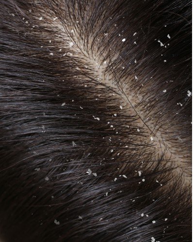 2. Close-up of a scalp with dark hair showing signs of dandruff and irritation